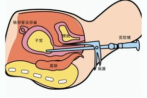 做宮腔鏡有這３種麻醉方式！