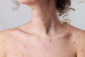 水痘並非兒童“專利”