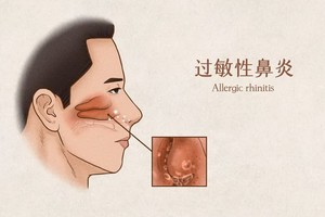 過敏性鼻炎發作期間不能使用抗生素