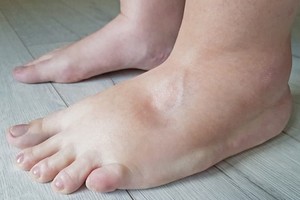 別誤會水腫時不能喝太多水