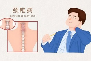 頸椎病術後不能大意