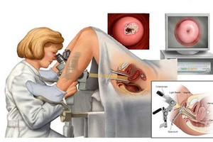 宮腔鏡或會對子宮造成傷害