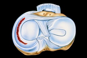 半月板損傷是怎麼造成的？