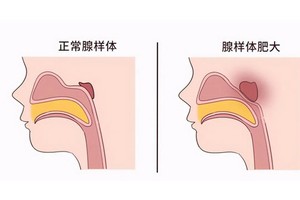 腺樣體腫大會帶來３大健康隱患