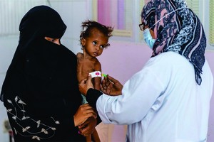 一歲多女孩在也門一家醫院接受營養不良治療。（圖：互聯網）