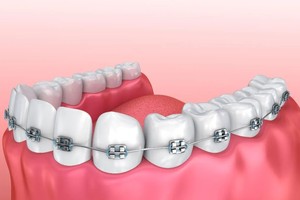 牙齒矯正前要知道各問題