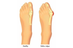脚踇趾外翻很难看需要看病治疗？