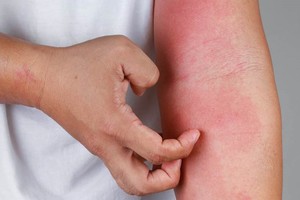 身体红痒脱屑、抠破皮出水！