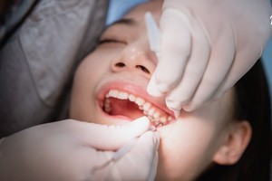 拔智齿后该如何照护？