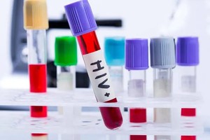 干细胞移植或可抑制爱滋病病毒