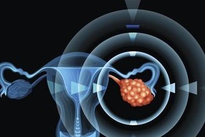 身体或发出３个卵巢癌“红色信号”