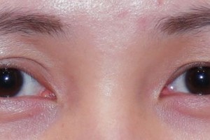 双眼皮浮肿小心甲状腺作怪