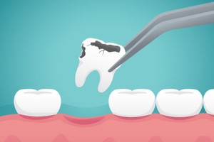 拔牙前须拍牙片、查血项