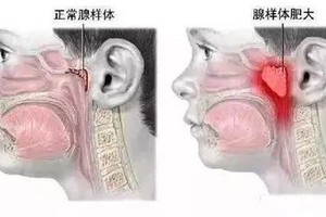 警惕孩子患上腺样体面容