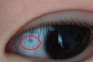 眼睛上出现白点或是患有睑缘炎？