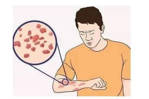 被隐翅虫、蜱虫、蜈蚣肆虐或咬怎么办？