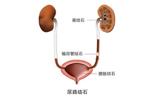 尿路结石患者日常注意事项