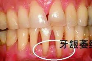 还在因牙龈萎缩烦恼？