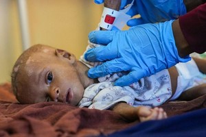 8个月大的易卜拉欣营养不良，在索马里首都摩加迪沙的一家医院里，医生正在测量他的臂围。（图：联合国）