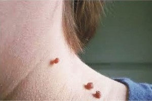 脖子上长“小肉粒”能直接用手揪掉？