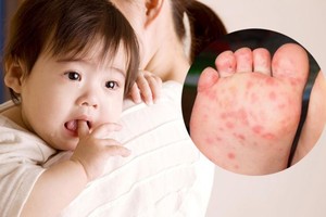 手足口病进入高发期，疫苗及卫生很重要