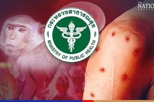 截至8月底，泰国共发现316例猴痘病例，其中8月新增145例，显示出疫情呈上升趋势。（示意图：泰国卫生部）