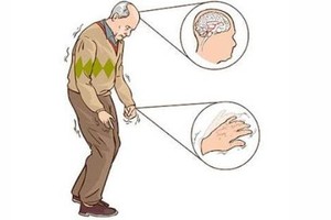 帕金森症状如何早发现？