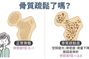 骨质疏松有什么症状？