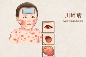 孩子反覆发热、眼睛红、起疹子？可能是川崎病的信号