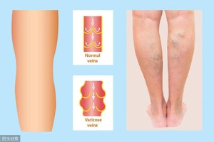 医生教你预防静脉血栓