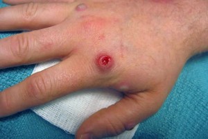 日本报告首例猴痘死亡病例