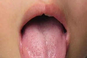 舌上有瘀斑要警觉恐有心脏病