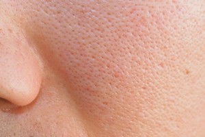 医生指出３原因让你毛孔变大