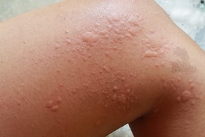 荨麻疹反覆发作 “想好的快”这事千万不能做