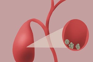 生活中的这些习惯，可能增加胆结石发生风险！