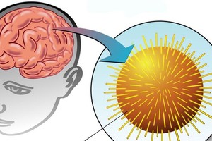 关于皰疹性脑炎你瞭解多少？