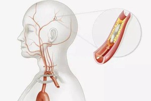 预防颈动脉狭窄