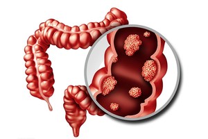 久“痔”不癒，小心这个病！