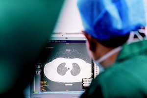 医生在查看患者肺部CT片，研究治疗方案。 （新华社资料图）