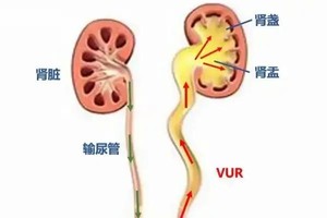 宝宝也会尿路感染？