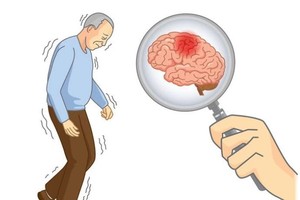 早晨是脑血管病变高发的时段。