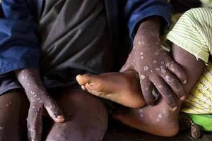 感染猴痘的刚果（金）病童。 （图：WHO）