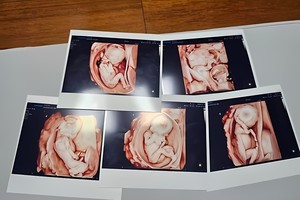 韩首例自然受孕五胞胎B超图像。（首尔圣母医院供图）