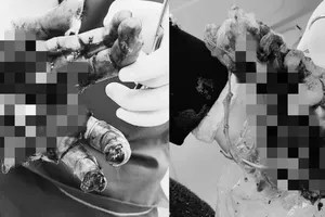 患者双手因爆竹爆炸受伤。（图：院方提供）