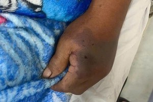 手背上的蛇毒牙咬痕。（图：日湖）