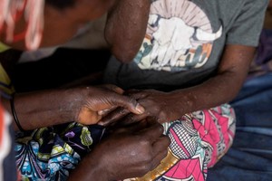 猴痘的初期症状包括发烧、头痛、肌肉酸痛、背痛、淋巴结肿大，之后可发展为面部和身体大范围皮疹。（图：路透社）