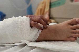 断掌成功移植到小腿上，为孕妇带来保留手部功能的希望。