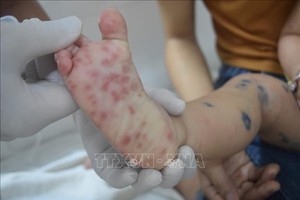 Bệnh tay chân miệng ở trẻ em. Ảnh: TTXVN 患有手足口病的病童。