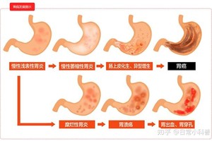 从胃炎到胃癌，只有4步！出现这些症状，别不当回事儿。