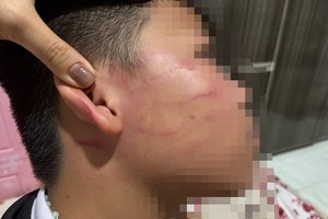 一名四年级学生遭补习教师殴打后留下的痕迹。家长提供的图片